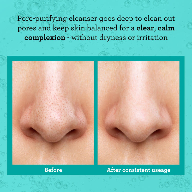 Bliss Clear Genius Cleanser before and after on model