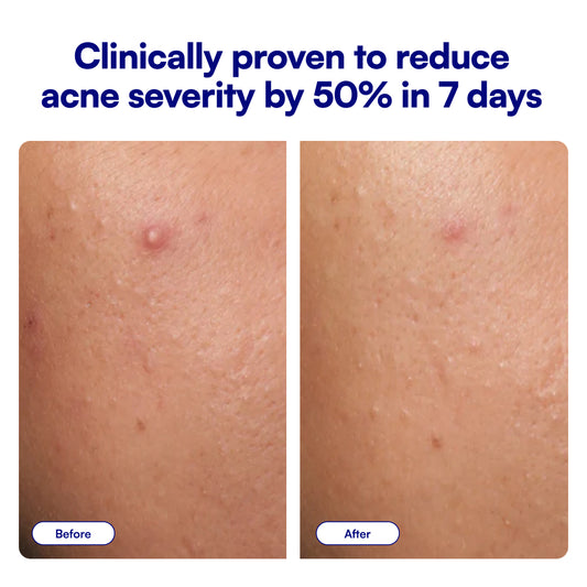 Clear Genius Acne Spot Treatment